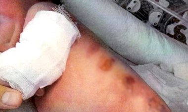 DOĞUMHANEDE ISITICI İLE YANAN BEBEĞİN AİLESİNE 160 BİN TL TAZMİNAT